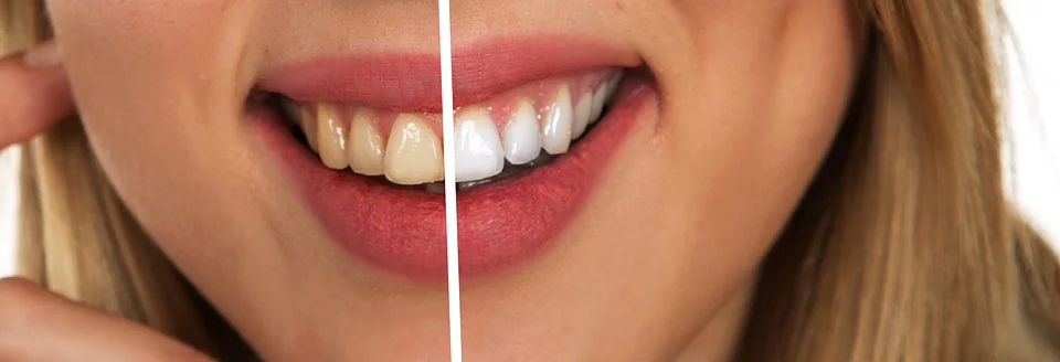 Efekt wybielania zębów